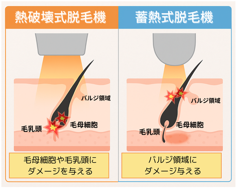 GentleMax Pro Plus 医療レーザー脱毛