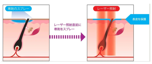GentleMax Pro Plus 医療レーザー脱毛